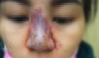 Tiêm filler để nâng mũi, người phụ nữ gặp biến chứng, có nguy cơ bị mù 