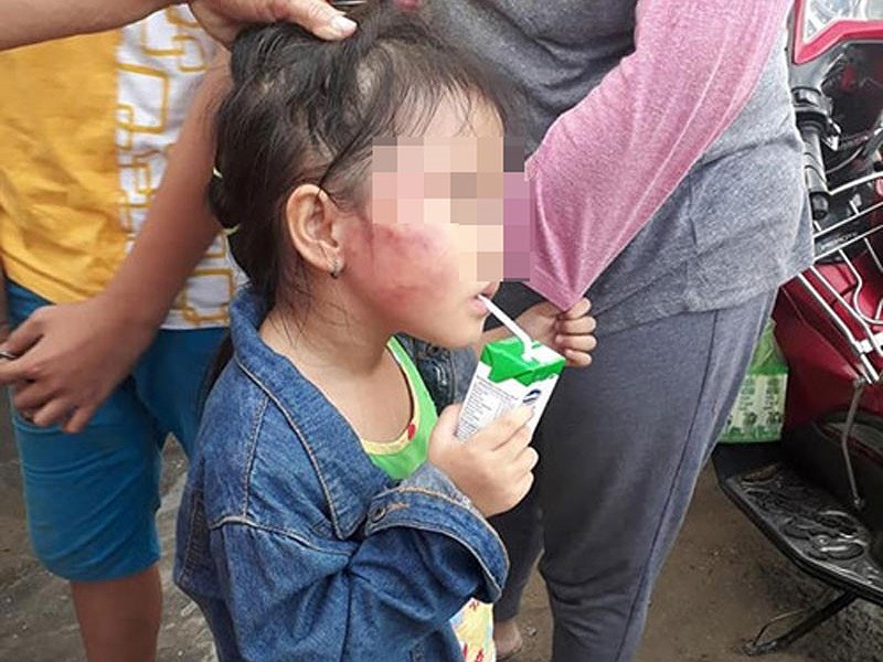 Cô giáo nghi đánh bé gái 5 tuổi nứt xương hàm ở Bình Chánh