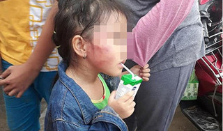 Bé gái 5 tuổi bị cô giáo tát nứt xương hàm có dấu hiệu sức khỏe kém