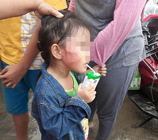 Gia đình bé gái 5 tuổi bị cô giáo tát sưng tím mặt cầu cứu Hội Bảo vệ quyền trẻ em