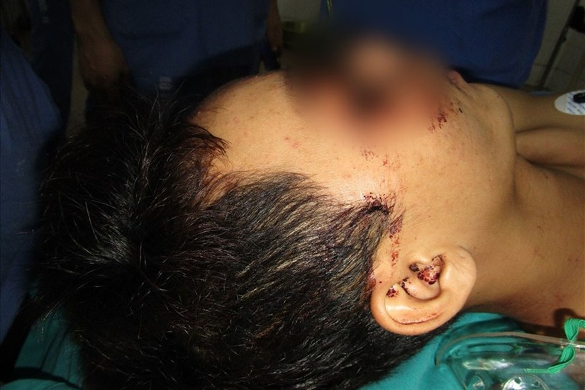 Tai nạn hy hữu: Nam thanh niên bị lưỡi cưa 12 cm găm giữa mặt
