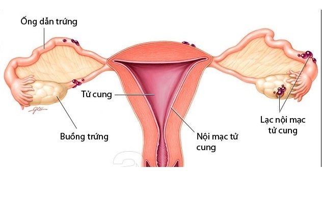 Lạc nội mạc tử cung là nguyên nhân gây ra vô sinh, hiếm muộn ở nữ giới