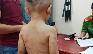 Bé trai 3 tuổi bị cha dượng dùng thắt lưng đánh gây thương tích nặng