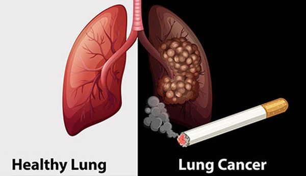 Dấu hiệu ung thư phổi nhưng dễ bị nhầm là bệnh của dân văn phòng 2