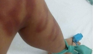 Bé trai 4 tuổi bị người tình của mẹ bạo hành đến nguy kịch 