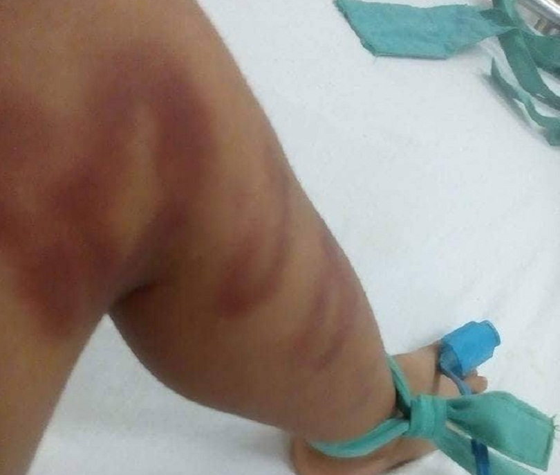 Bé trai 4 tuổi bị người tình của mẹ bạo hành đến nguy kịch 