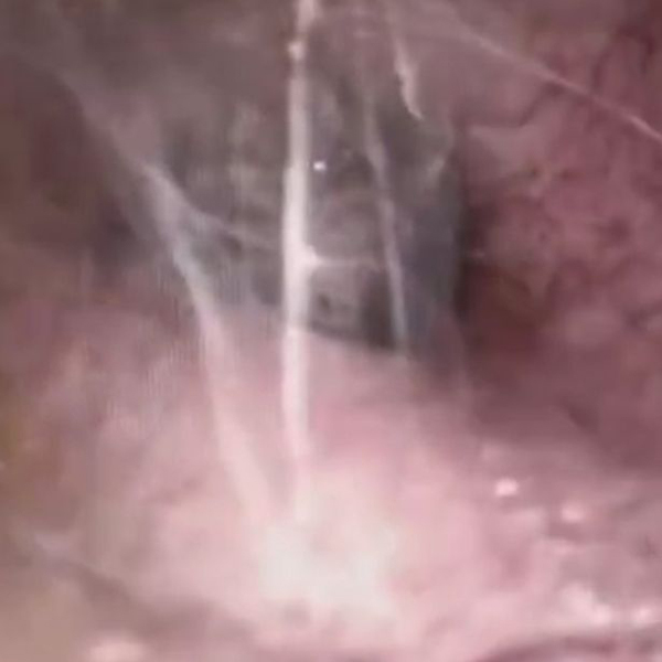 Nhện chui vào tai người làm tổ, giăng tơ