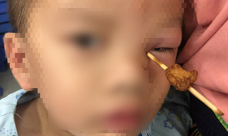 Xót thương hình ảnh bé 4 tuổi bị que thịt xiên đâm vào hốc mắt