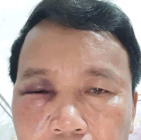 Chủ tịch xã Hoàn Trạch bị đánh bầm mắt