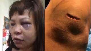 Nữ hộ lý bị chồng đánh tím mặt, cắt gân chân ở Quảng Ninh