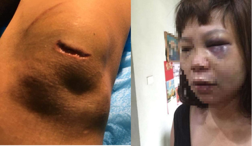 Khởi tố người chồng cắt gân vợ ở Quảng Ninh