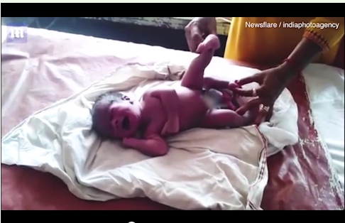 em bé có 4 chân, 2 cơ quan sinh dục hạ sinh ở Ấn Độ