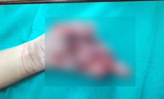 Nghệ An: Điện thoại phát nổ, bé trai 7 tuổi dập nát cả bàn tay