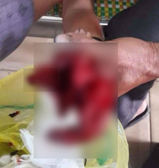 Nghệ An: Điện thoại phát nổ, bé trai 7 tuổi dập nát cả bàn tay