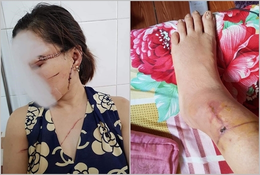 'Vợ hờ' bị chồng dùng dao cắt gân chân ở Bắc Giang thương tổn đến đâu?