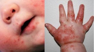 Chủng virus EV71 đang gây bệnh tay chân miệng hàng loạt nguy hiểm ra sao?