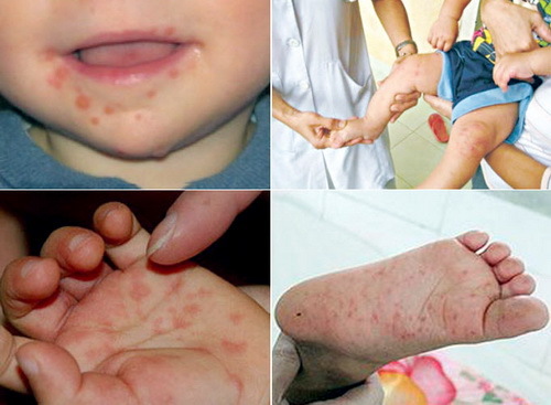 Sẽ sớm có vắc xin phòng bệnh tay chân miệng do EV71 cho trẻ em?