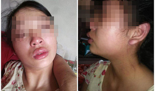 Vợ 16 tuổi lên MXH tố chồng bạo hành dã man: Công an Quảng Bình vào cuộc