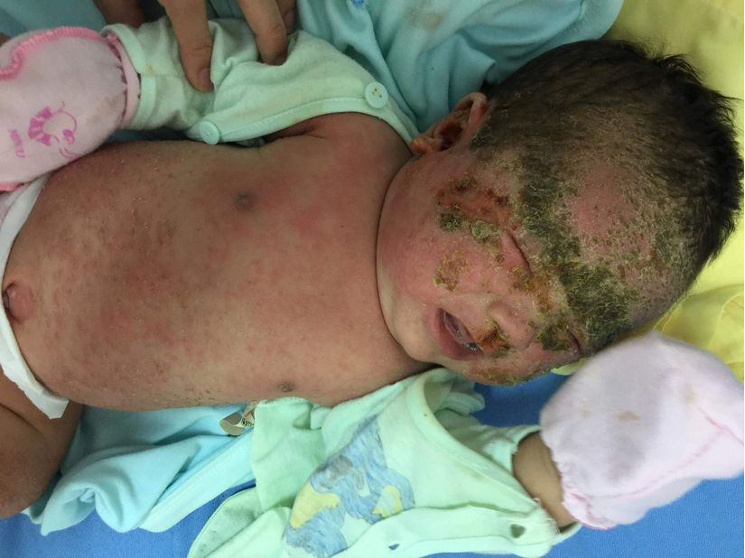 Bé sơ sinh bị bong tróc cả mảng da mặt vì tắm lá chữa mẩn ngứa