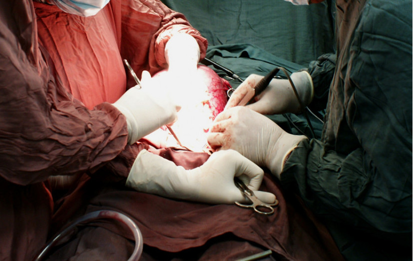 Sản phụ mang song thai ngưng tim trong lúc mổ bắt con