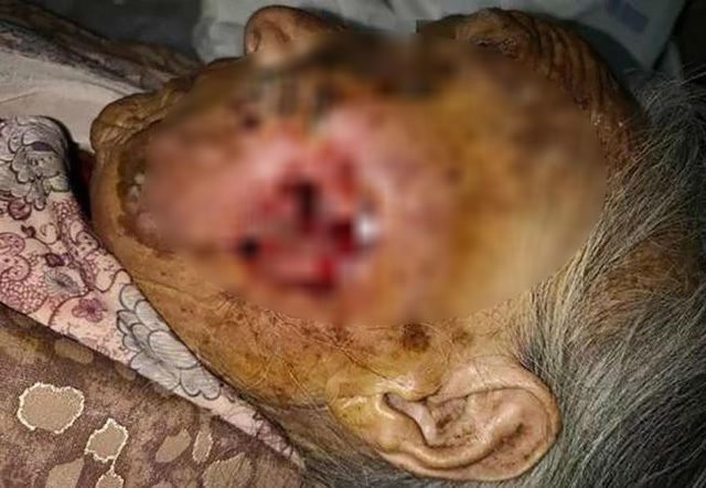 Giòi nhung nhúc làm tổ, ăn thịt sống trên gương mặt bà lão 97 tuổi