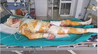 Chàng trai bị bỏng 95% cơ thể ở Hà Nam do cứu hàng xóm khỏi hỏa hoạn đã qua đời