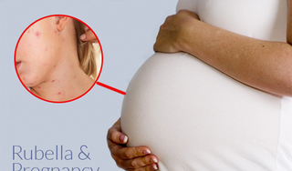 Mẹ nhiễm rubella trong thai kỳ, trẻ nguy cơ bị dị tật bẩm sinh