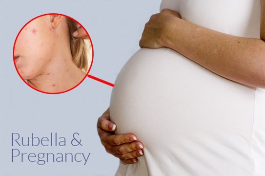 Mẹ nhiễm rubella trong thai kỳ trẻ dị tật bẩm sinh