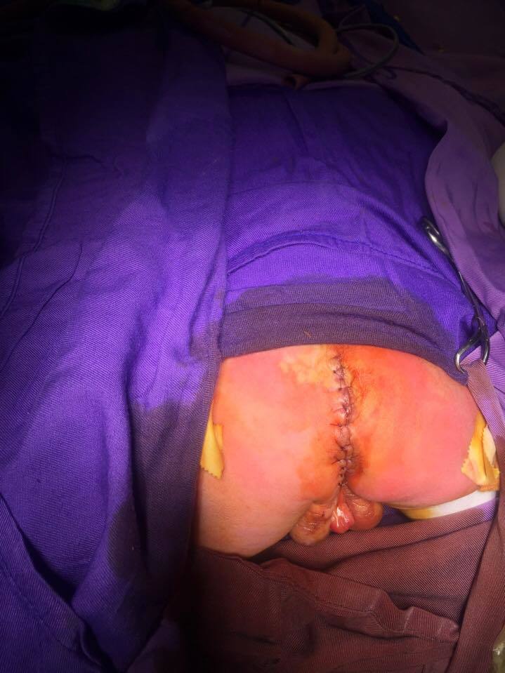 Phẫu thuật cắt khối u quái cho bé 1 ngày tuổi
