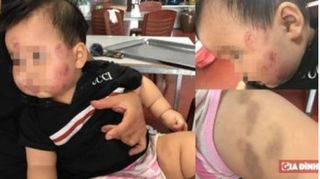 Trẻ 10 tháng tuổi bị tím đùi, xước mặt sau khi từ trường mầm non về nhà