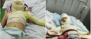 Nướng mực bằng cồn, cả gia đình bỏng nặng, bé 2 tuổi tử vong