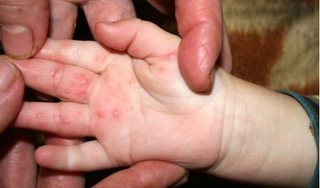 Sai lầm 'chết người' khi chăm trẻ tay chân miệng có thể gây biến chứng nặng