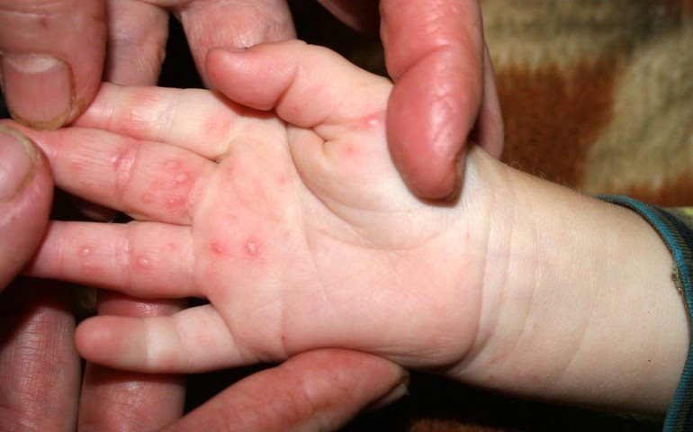Sai lầm của cha mẹ khi chăm trẻ tay chân miệng dễ gây biến chứng