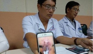 Nữ sinh ở Sài Gòn hoại tử mất 2/3 mũi sau tiêm chất làm đầy nâng mũi 