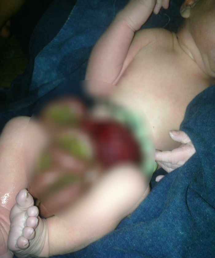 Bé gái sơ sinh bị lòi ruột bẩm sinh ở Hà Giang