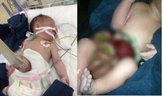 Xót xa bé gái sơ sinh bị 'xổ' ruột ngoài ổ bụng, chỉ được cắt dây rốn bằng cây nứa