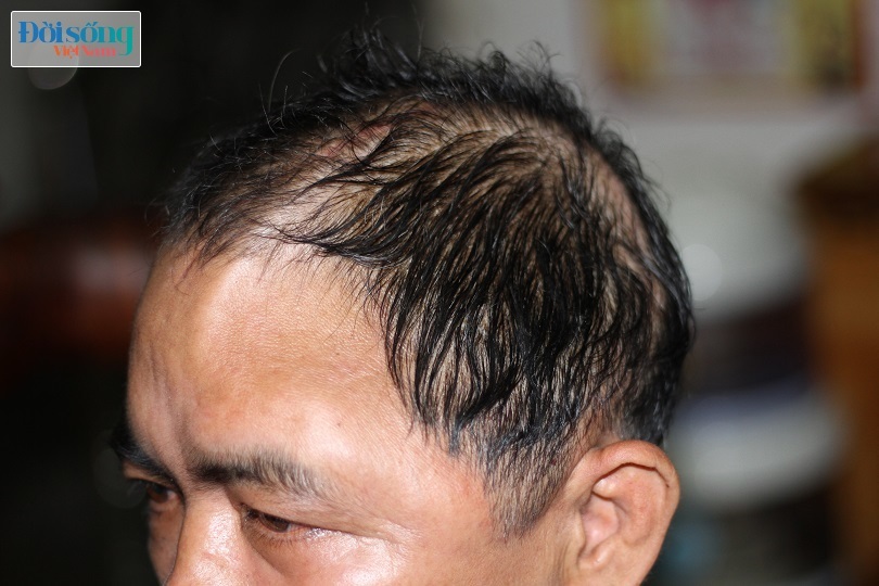 Nam Định: Người đàn ông mất một nửa hộp sọ sau vụ tai nạn giao thông kinh hoàng2