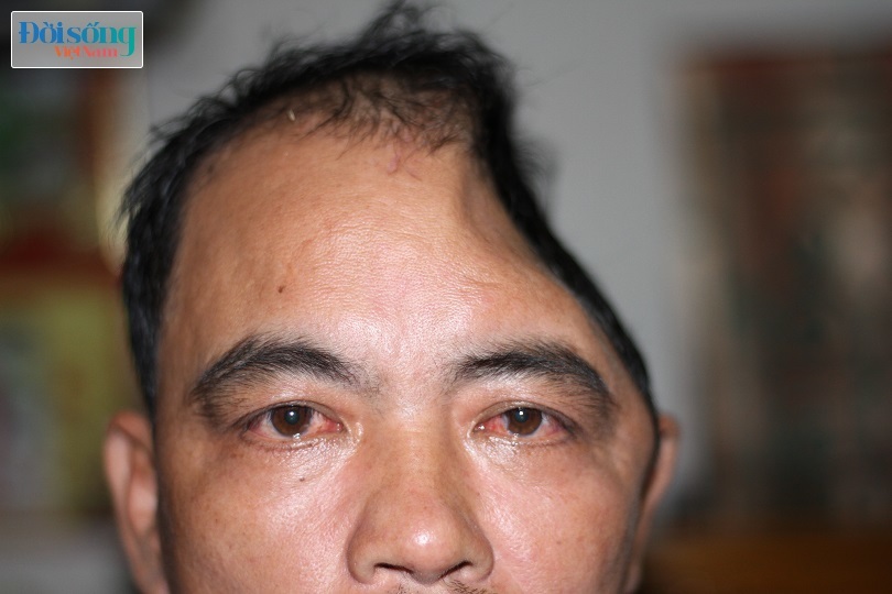 Nam Định: Người đàn ông mất một nửa hộp sọ sau vụ tai nạn giao thông kinh hoàng5