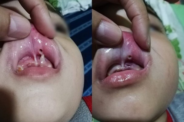 Bé trai bị răng đâm thủng môi, bác sĩ cảnh báo sai lầm của phụ huynh