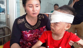 Thanh Hóa: Bé trai 6 tuổi bị chó nhà cắn rách mặt, tổn thương mắt nghiêm trọng 
