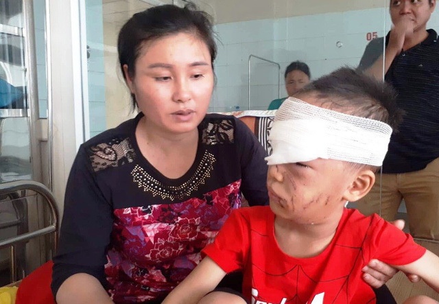 Kinh hoàng bé trai ở Thanh Hóa bị chó nhà cắn rách mặt