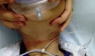 Bé trai 6 tuổi suýt chết vì tự thắt dây nhựa vào cổ