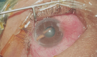 Suýt mất thị lực vì dụi mắt: Bác sĩ cảnh báo thói quen nguy hiểm