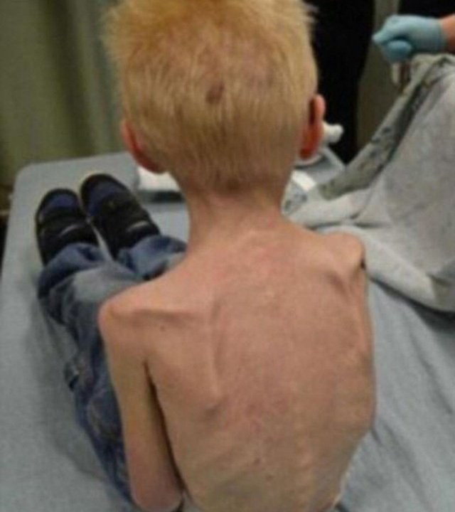 Cậu bé hóa 'bộ xương di động' vì mẹ kế bạo hành