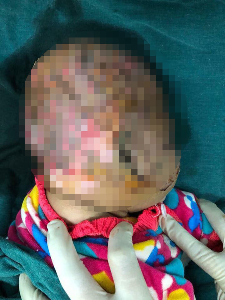 Cao Bằng: Sơ ý ngã vào bếp lửa, bé gái 10 tháng tuổi bị bỏng nặng