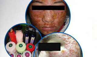 Nữ sinh 19 tuổi biến dạng da mặt vì tự làm đẹp đón Tết