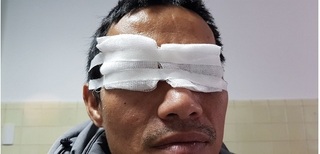 Người đàn ông bị bỏng giác mạc, nguy cơ mù mắt vì đốt pháo hoa chơi Tết
