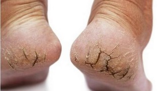 Ung thư da từ vết nứt gót chân và những dấu hiệu rất dễ bỏ qua