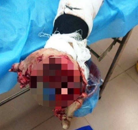 Nam Định: Thiếu niên 17 tuổi bị nát bàn tay vì vừa sạc vừa dùng điện thoại
