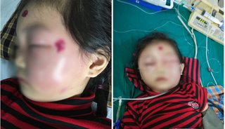 Bé gái 6 tuổi ở Phú Thọ suýt mất mạng chỉ vì nốt mụn nhỏ trên mặt